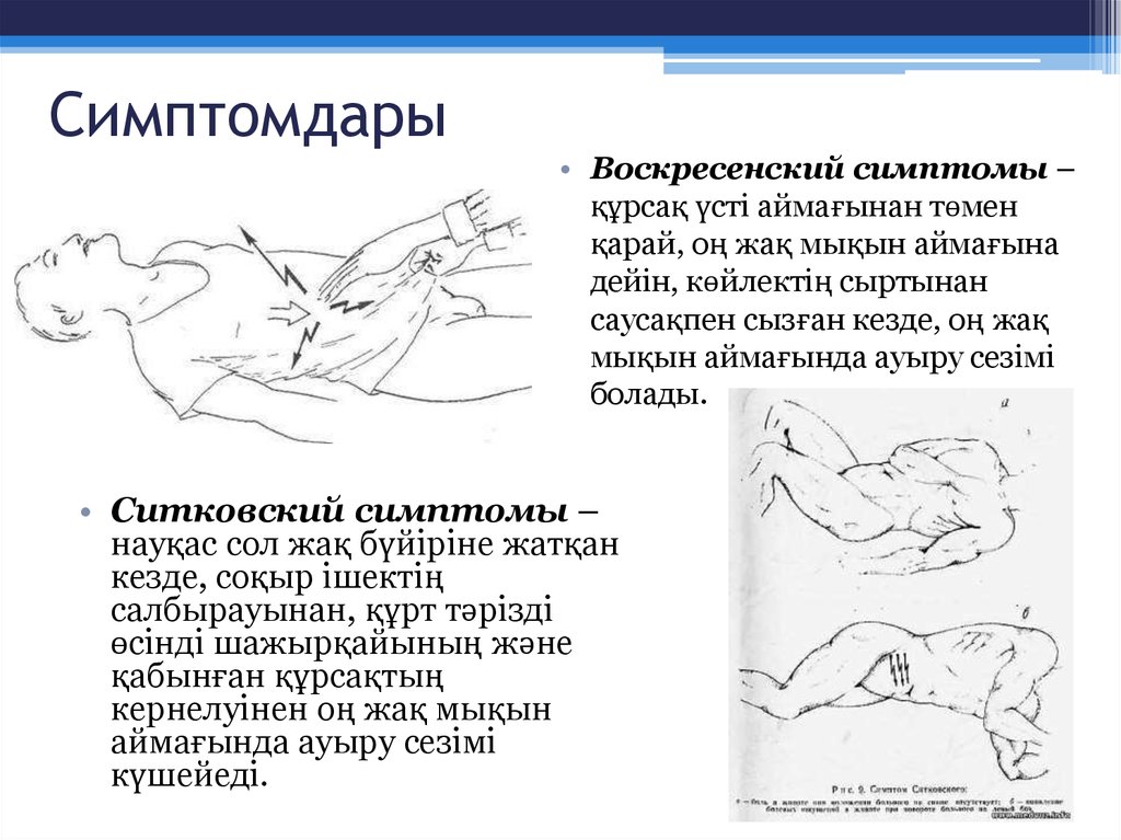 Бартомье михельсона. Симптом кертэ Воскресенского. Симптом Воскресенского рубашки. Симптом Воскресенского при. Симптом Воскресенского при аппендиците.