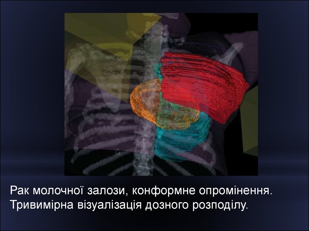 Лучевая терапия при раке молочной. Трехмерная конформная лучевая терапия. Лучевая терапия молочной железы. Осложнения при лучевой терапии. Цель лучевой терапии.