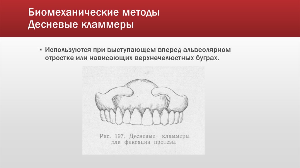 Методы фиксации и стабилизации съемных протезов при полном отсутствии зубов презентация