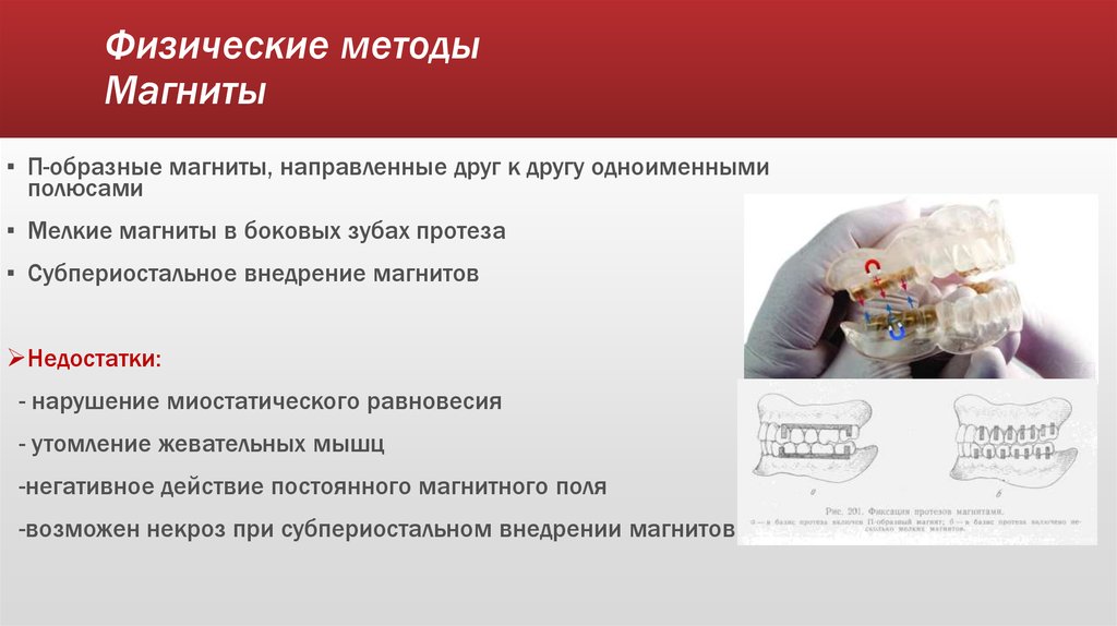 Методы фиксации и стабилизации съемных протезов при полном отсутствии зубов презентация