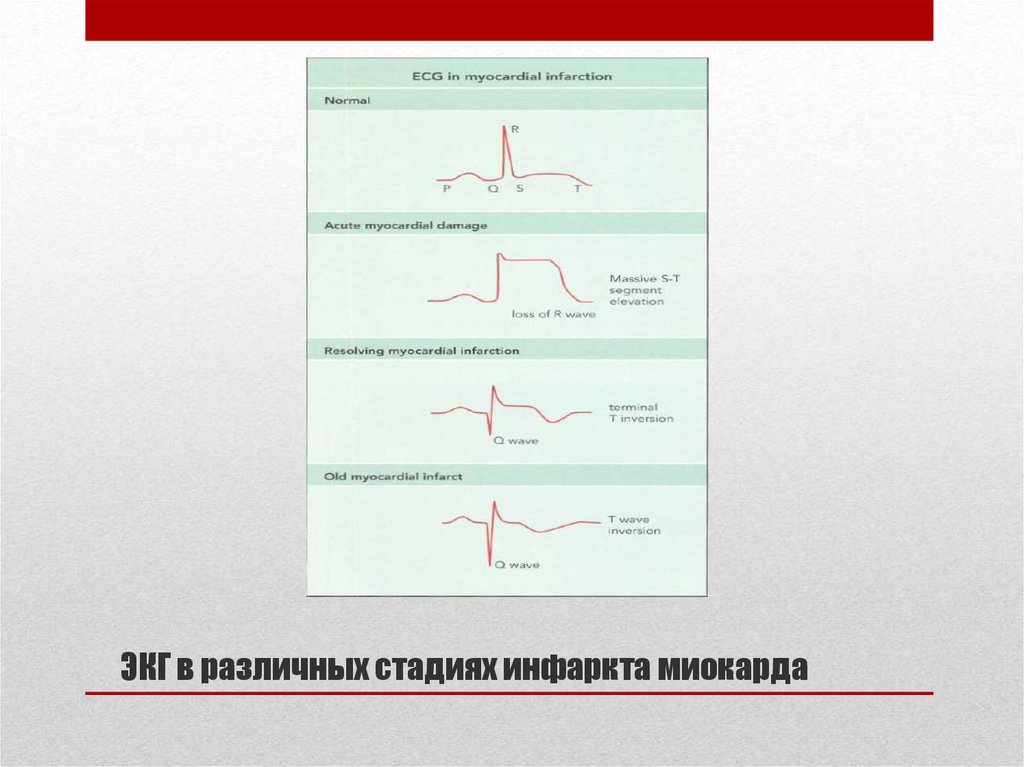 Стадии инфаркта миокарда. Патологический зубец q является признаком. Стадии инфаркта миокарда с зубцом q стадии. Классификация по стадиям инфаркта миокарда ишемия. ИБС классификация ЭКГ.