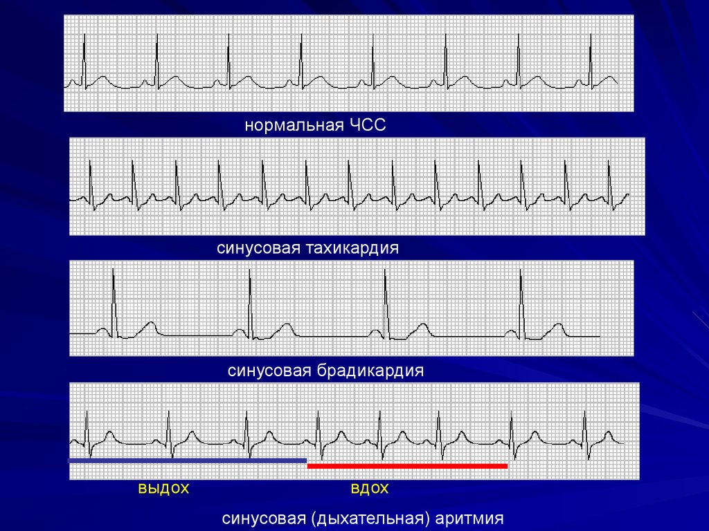 Синусовая аритмия это. Дыхательная аритмия на ЭКГ. Синусовый ритм дыхательная аритмия. Синусовая дыхательная аритмия на ЭКГ. Недыхательная синусовая аритмия на ЭКГ.