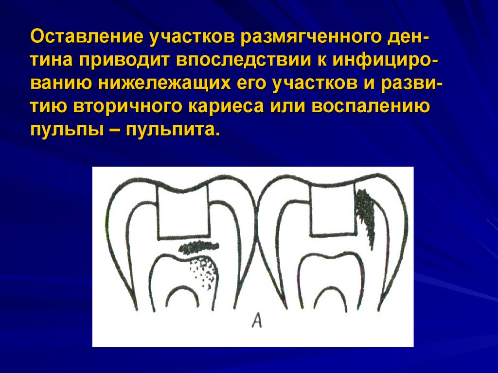 Ошибки и осложнения при диагностике и лечении кариеса презентация