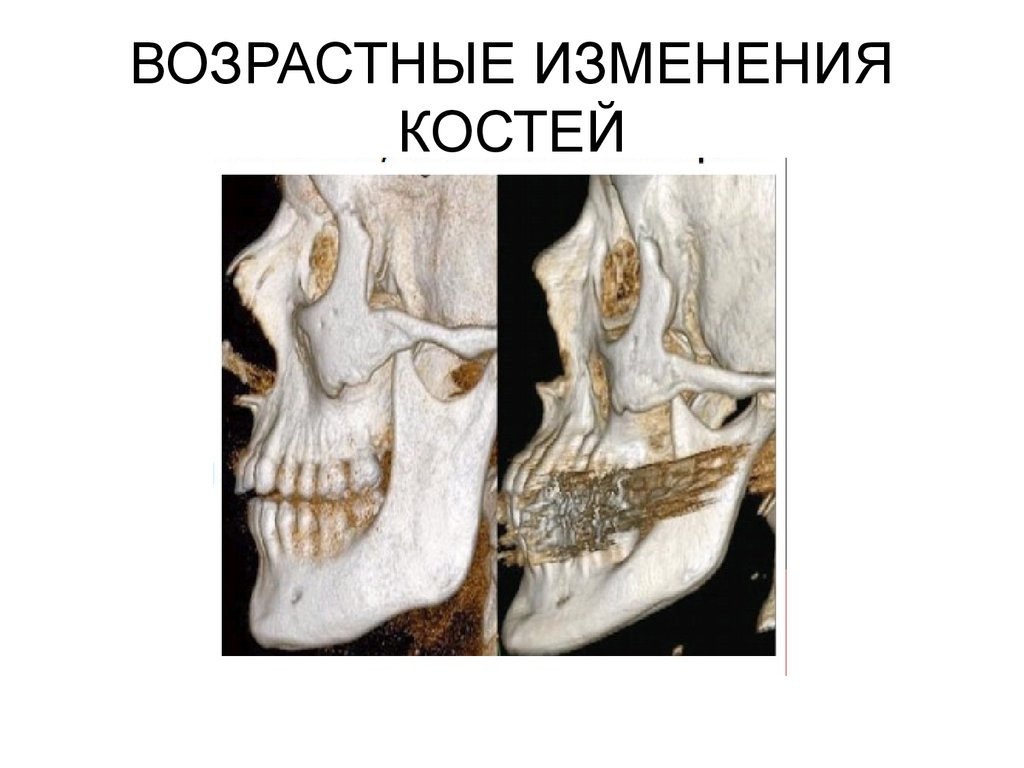 Основным признаком возрастных изменений костей