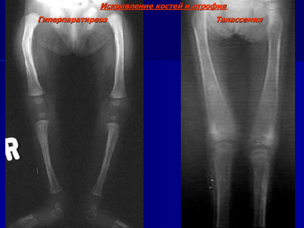 Деформация костей. Гиперпаратиреоз суставы. Гиперпаратиреоз поражение суставов. Гиперпаратиреоз кт костей. Болезнь деформация костей.