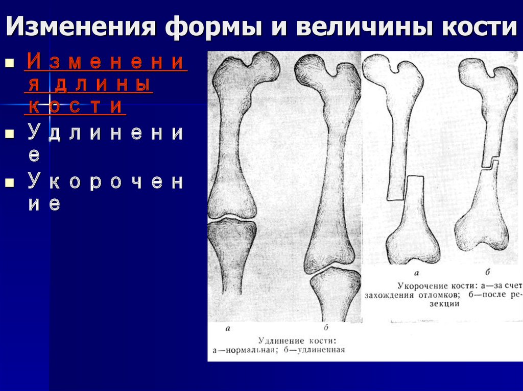 Изменения костей. Изменение формы костей. Изменение формы и величины костей. Изменения величины кости.. Модификация костей по форме.