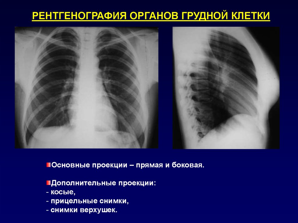 Рентгенография органов грудной. Рентген легких боковая проекция норма. Боковой рентген легких норма. Рентген ОГК норма. Рентген грудной клетки в боковой проекции норма.