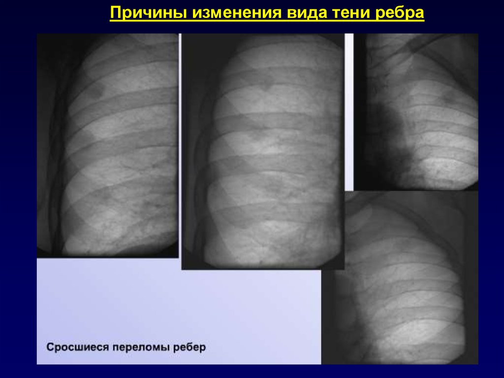 Трещина заживает. Рентген грудной клетки перелом ребер. Поднадкостничный перелом ребра. Сросшийся перелом ребра.