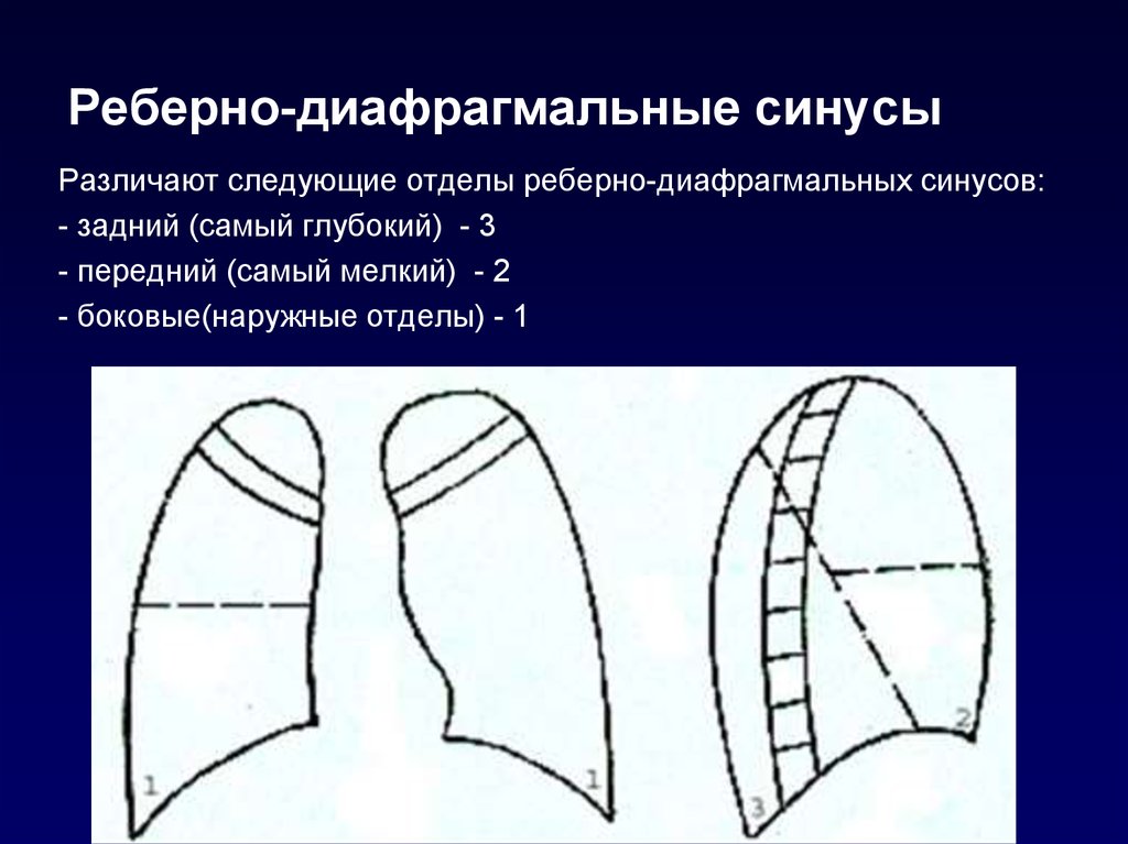 Реберно диафрагмальный синус. Реберно медиастинальный синус. Ркбернодиафрагиальный синцс. Ребро-диафрогмальные синусы.