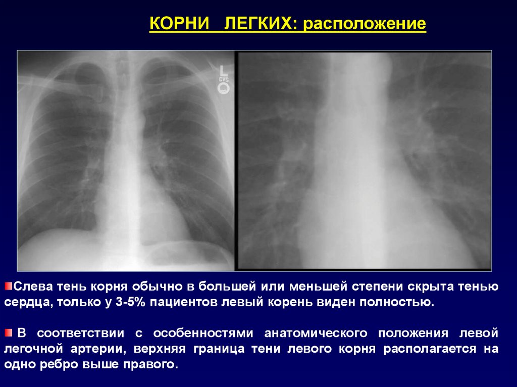 Тени средней интенсивности в легком