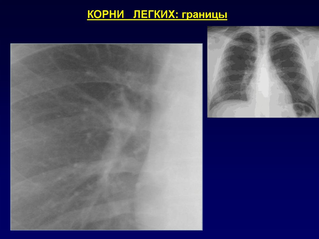 Легко корень. Рентген уплотнение корня лёгкого. Корни лёгких на рентгенограмме. Патология корня легкого рентген. Корень легкого на рентгенограмме в норме.