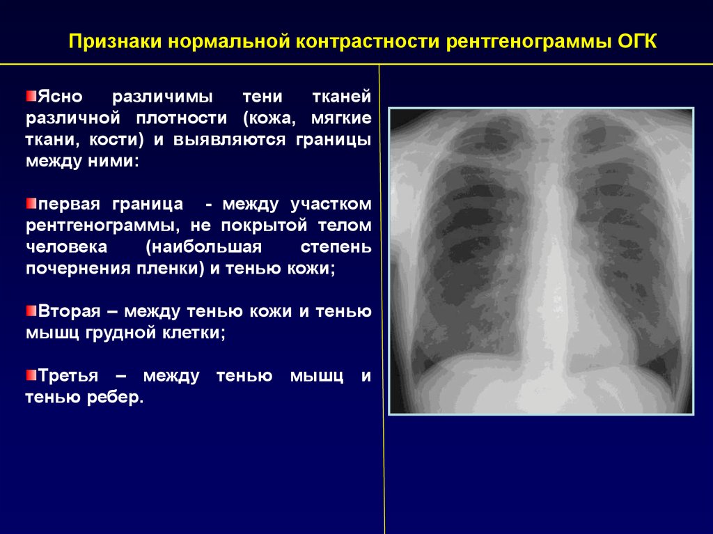 Без видимых патологий. Рентген снимка ОГК В норме. Нормальный рентген ОГК У детей. Норма протокола грудной клетки рентген. Рентген органов грудной клетки норма описание.