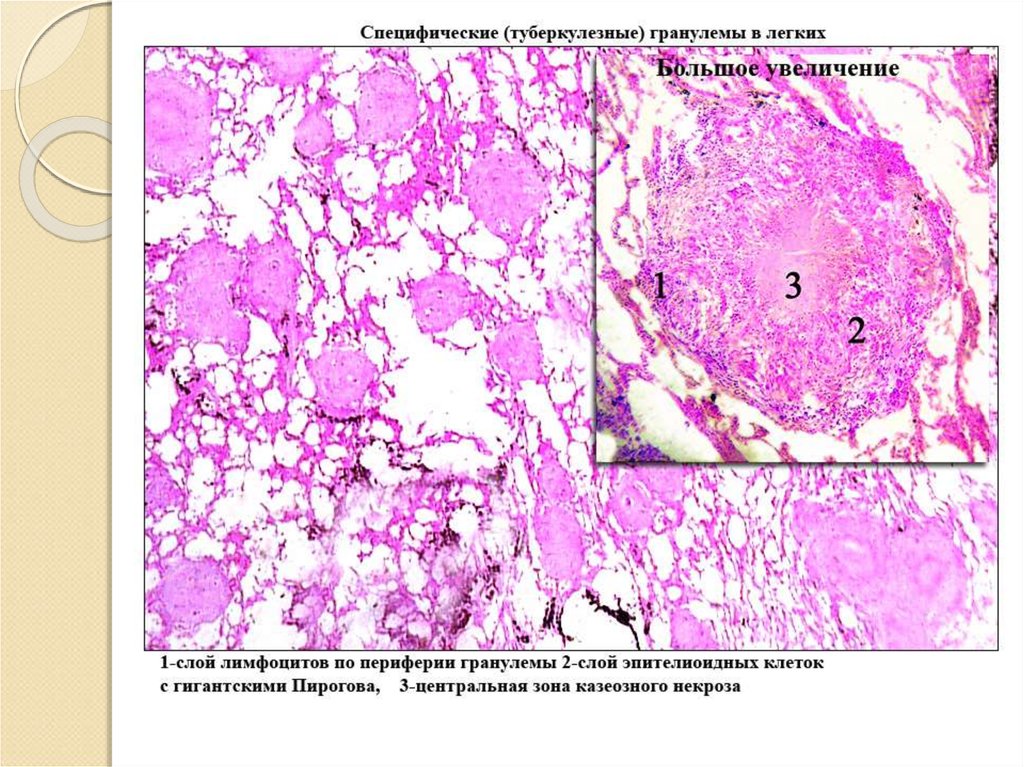 Гранулема это. Туберкулёзнач шранулема микр. Очаг казеозного некроза в легком микропрепарат. Туберкулезная гранулема в легком микропрепарат. Гранулема туберкулез микропрепарат.