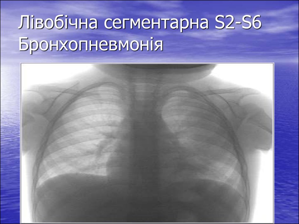 Бронхопневмония у детей. Правосторонняя бронхопневмония. Двухсторонняя бронхопневмония. Бронхопневмония справа. Бронхопневмония рентген.