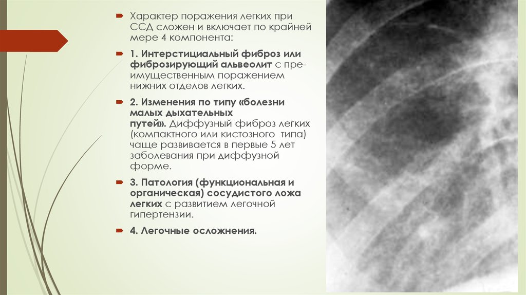 Интерстициальные изменения в легких что это. Поражение легких при системной склеродермии. Склеродермия легких на кт. Интерстициальные заболевания легких рентген. Системная склеродермия поражение легких кт.