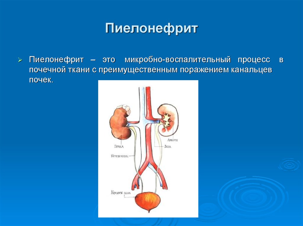 Пиелонефрит человека. Воспалительный процесс в почках. Поражение почечных канальцев.