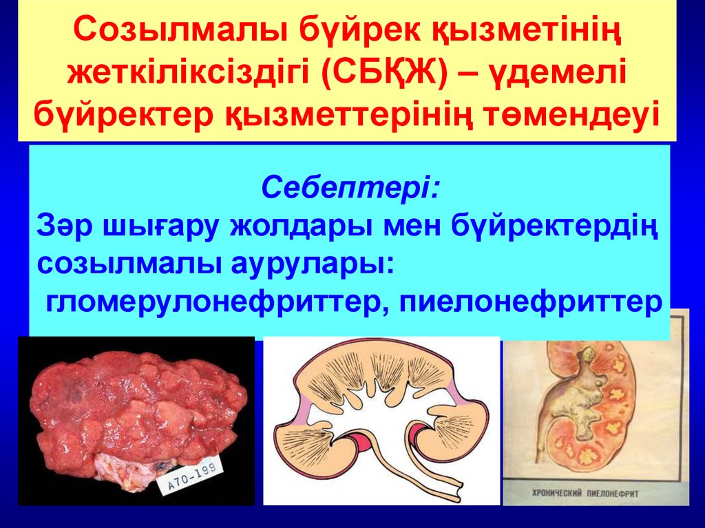 Созылмалы гломерулонефрит презентация