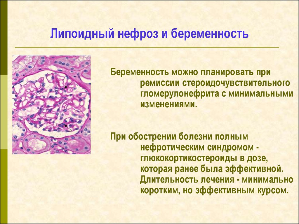 Нефроз почек