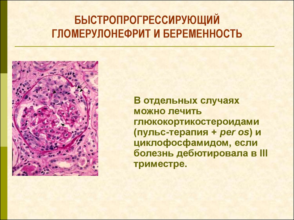 В отдельных случаях. Быстропрогрессирующий гломерулонефрит с полулуниями. Быстропрогрессирующий гломерулонефрит этиология. Быстропрогрессирующий гломерулонефрит гистология. Гломерулонефрит с полулуниями этиология.