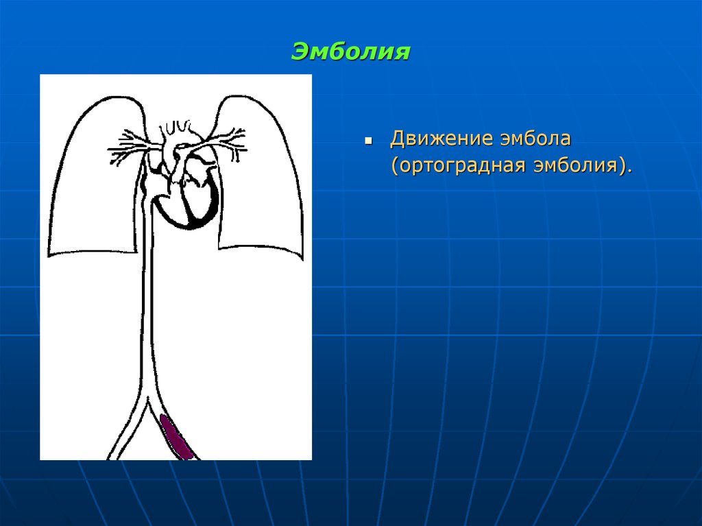 Направление движения эмболов рисунок