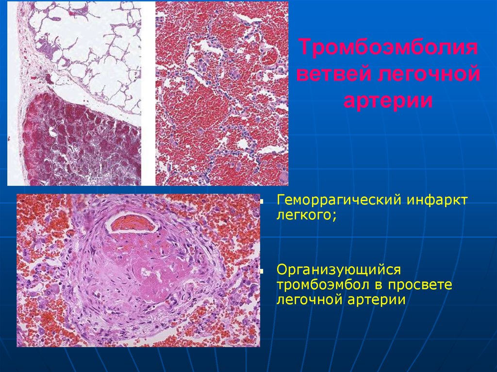 Тромб микропрепарат. Тромбоз сосудов патанатомия. Геморрагический инфаркт легкого патанатомия. Тэла патологическая анатомия микропрепарат. Тромбофлебит классификация патологическая анатомия.