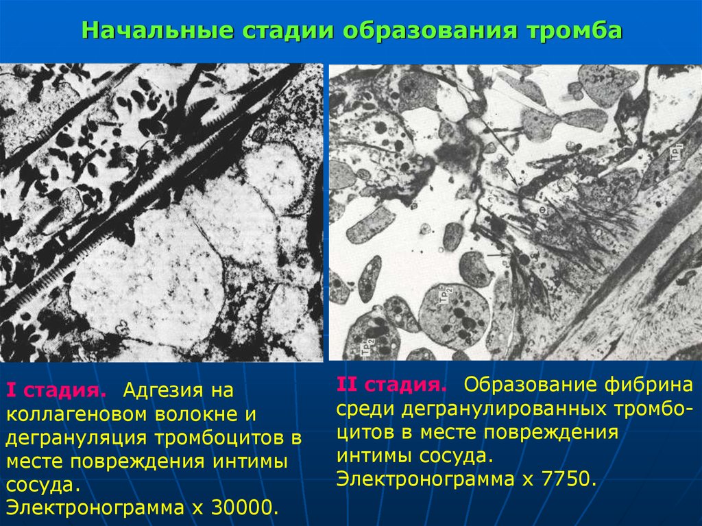 Тромбоз образование. Вторая стадия образования тромба Электронограмма. Тромбоцит Электронограмма. Электронограмма первая стадия образования тромба. Стадии тромбообразования.