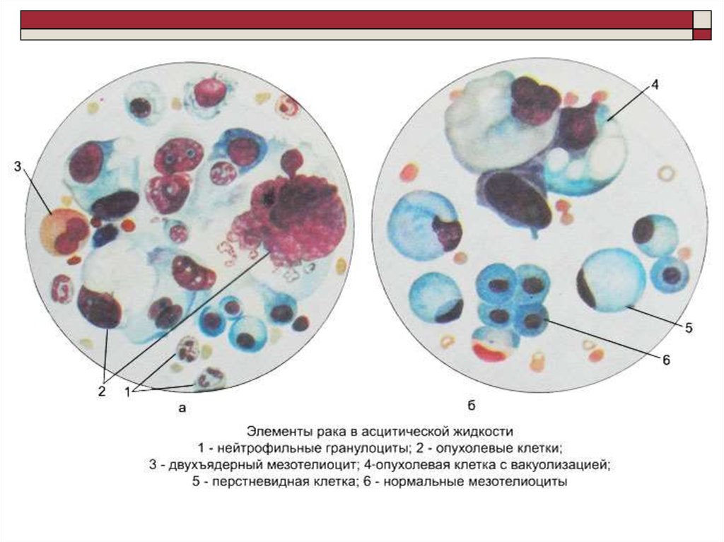 Цитологическая картина мезотелиомы