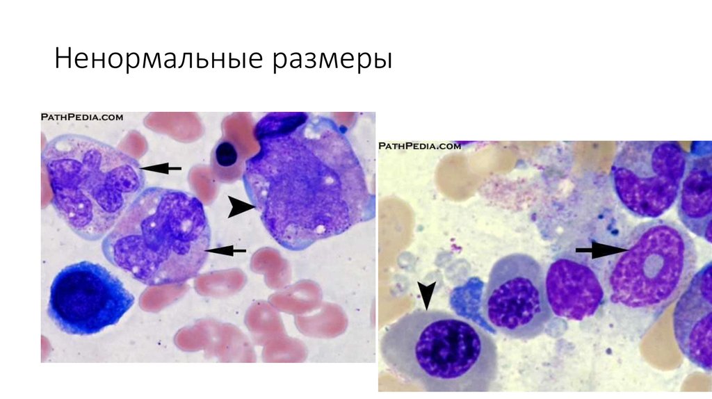 Миелодиспластический синдром презентация