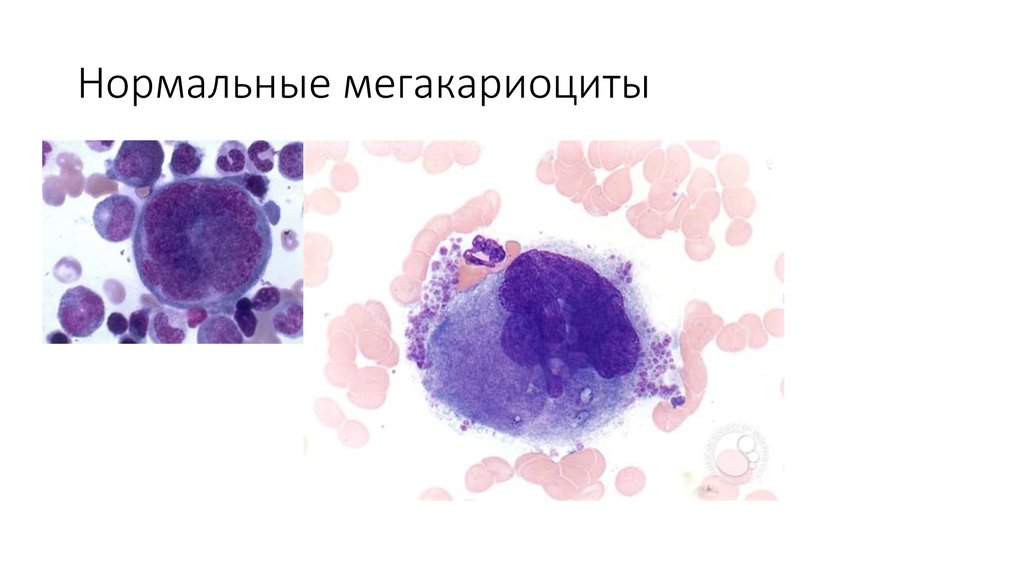 Миелодиспластический синдром презентация