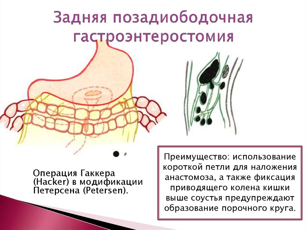 Анастомоз по брауну схема