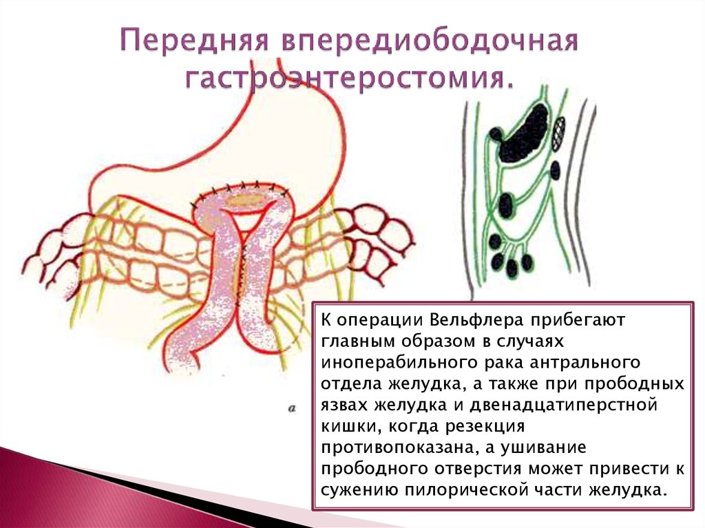 Анастомоз по брауну схема