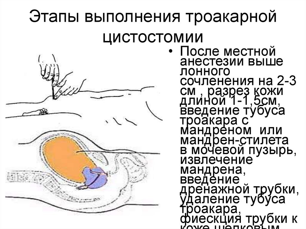 Цистостома мочевого пузыря у мужчин