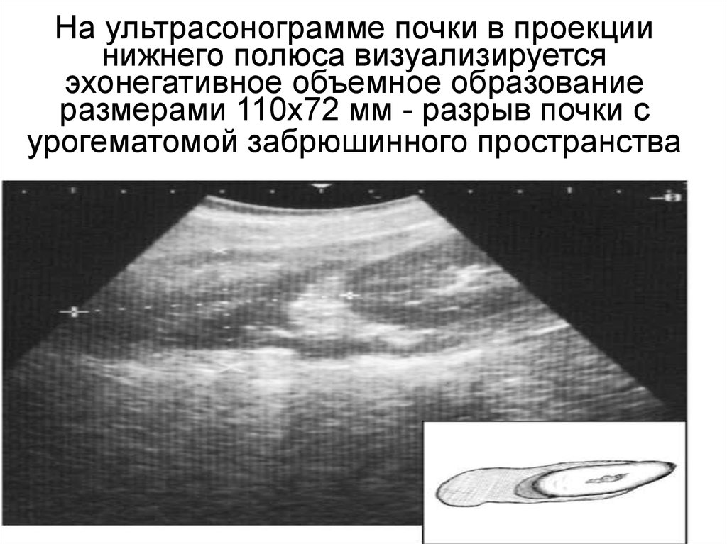 Характеристика эхонегативного изображения