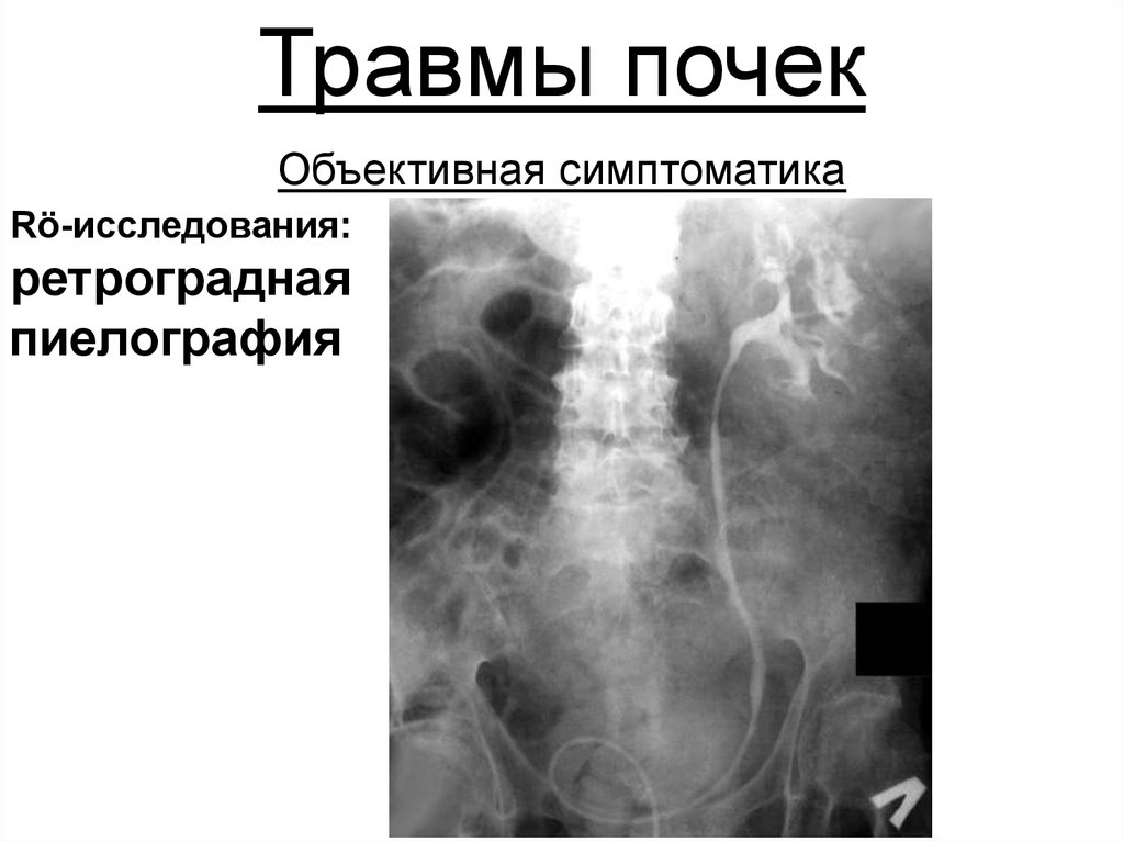 Травмы почек презентация