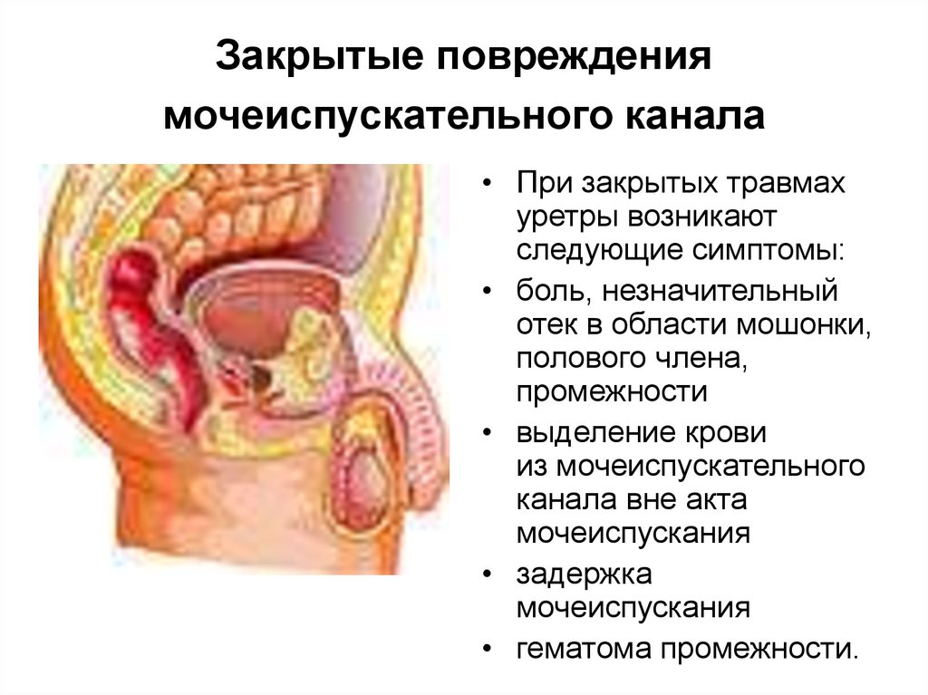 Кровотечение у мужчины. Кровотечение из полового члена. Кровь из мочеиспускательного канала. Закрытые повреждения уретры.