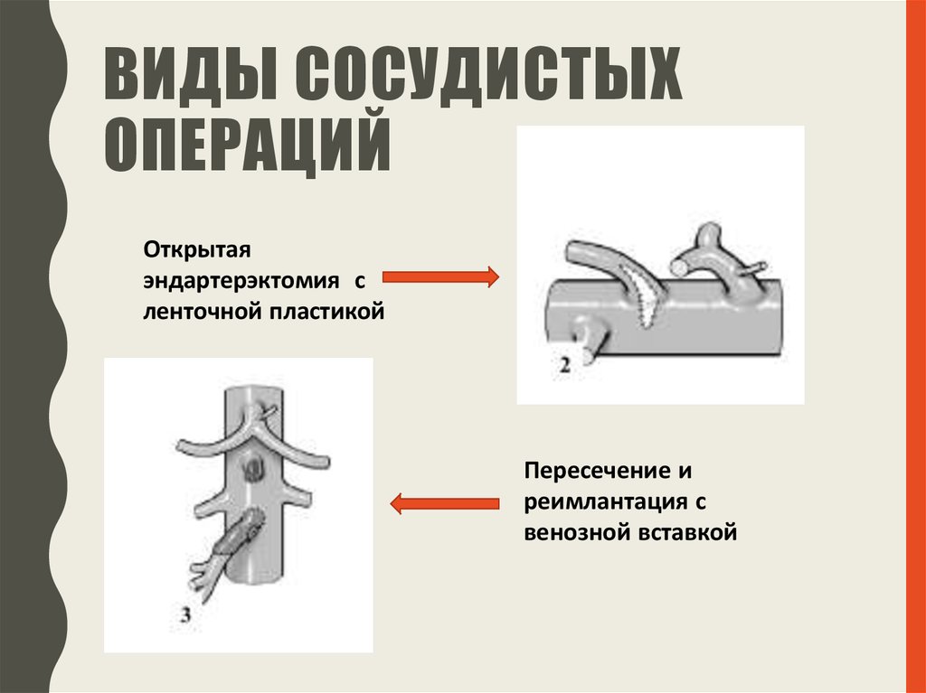 Мезентериальной компрессии