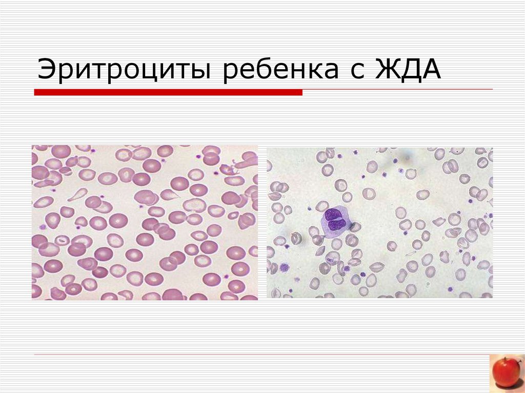 Картина периферической крови при железодефицитной анемии