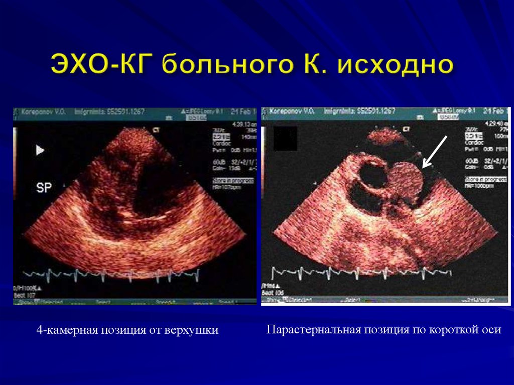 ЭХО-КГ больного К. исходно