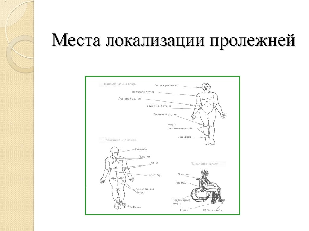 Места образования пролежней схема