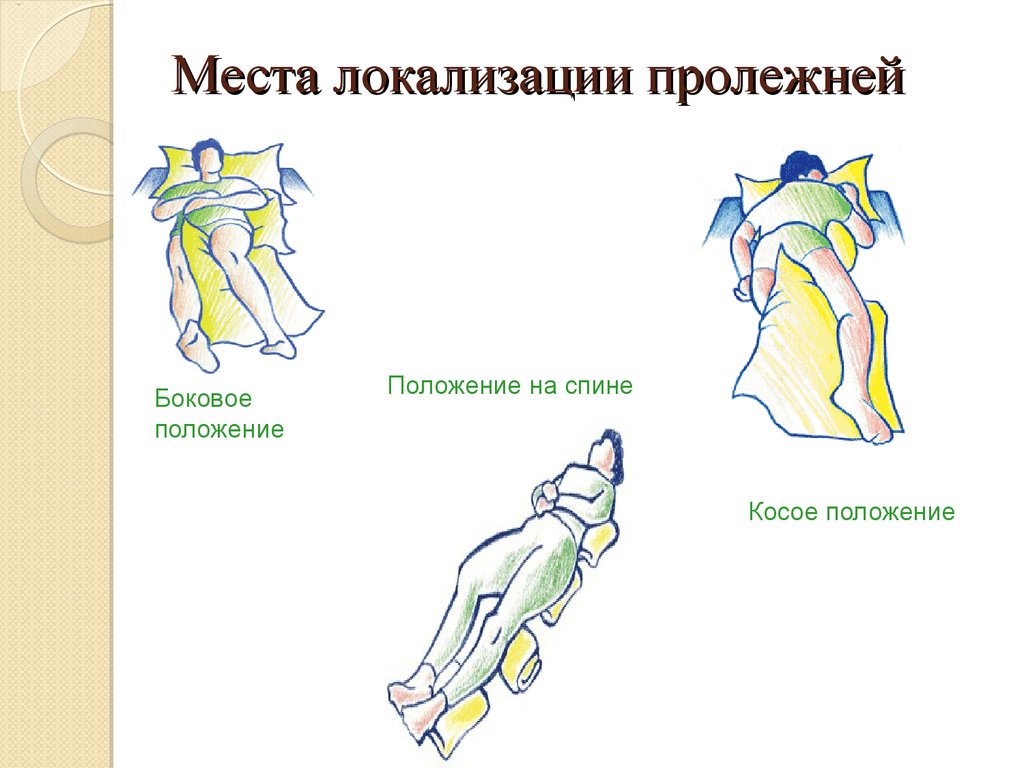 Места образования пролежней. Локализация пролежней при положении на спине. 37 % Пролежней локализуются на.