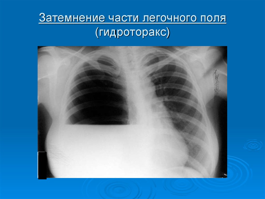 Поле легкого. Синдром гидроторакса рентген. Тотальный левосторонний гидроторакс рентген. Синдром обширного просветления легочного поля пневмоторакс. Рентген грудной клетки гидроторакс.