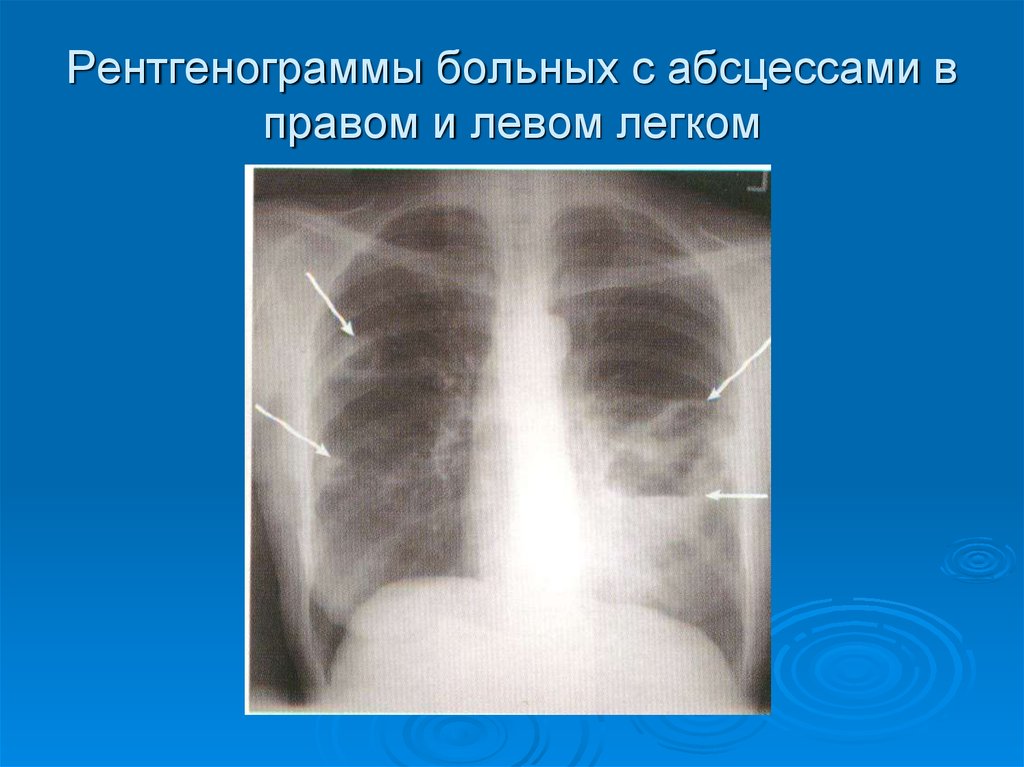 Рентгенологическая картина при абсцессе