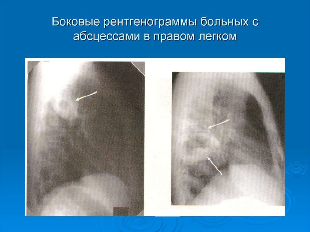 Боковые рентгенограммы больных с абсцессами в правом легком
