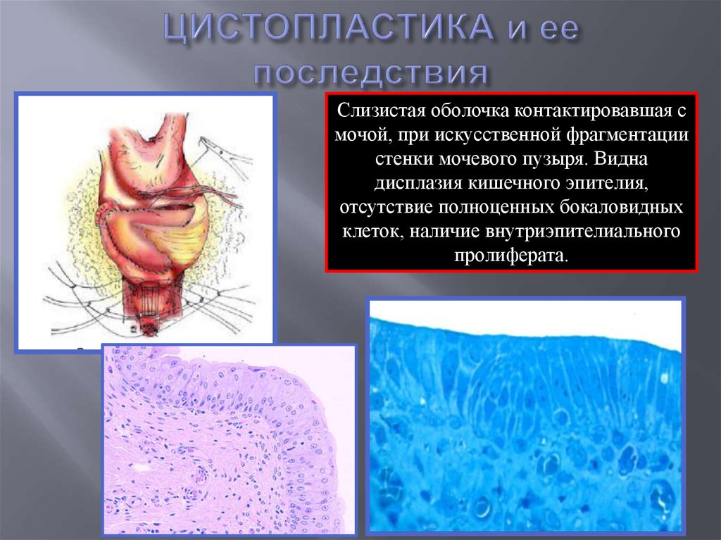 Стенки мочевого пузыря. Цистопластика мочевого пузыря. Аугментационная цистопластика. Кишечная цистопластика. Ортотопическая цистопластика.