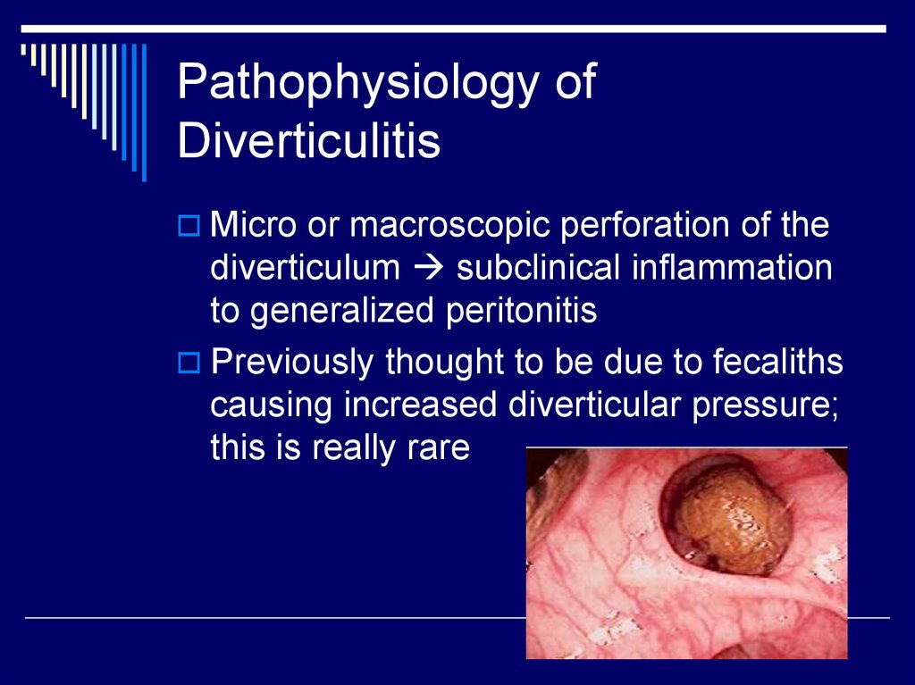 Antiinflamatorio para diverticulitis