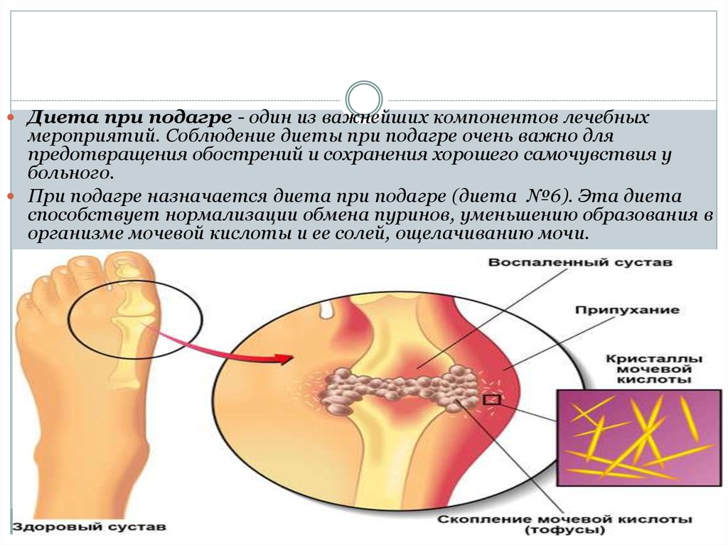 Мочевая подагра диета. Подагра диета. Питание при подагре. Диета при подагре у женщин. Диета при подагре на ногах у женщин.