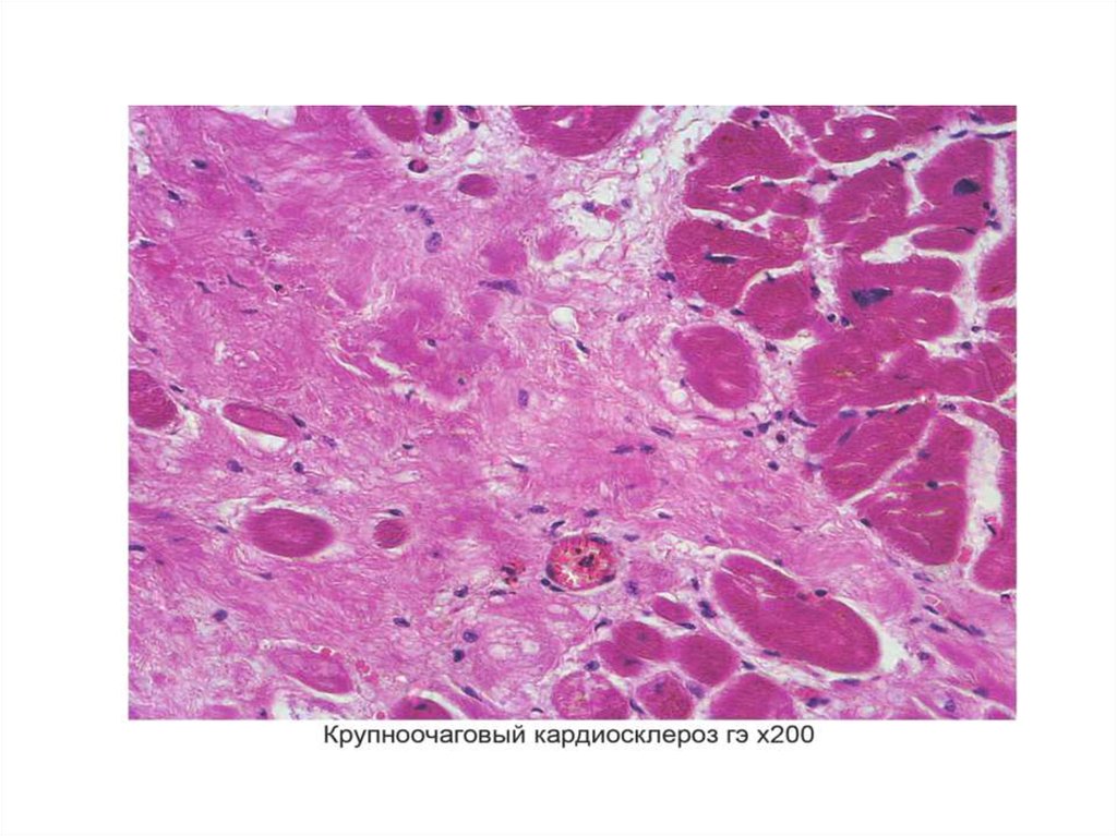 Кардиосклероз это. Постинфарктный крупноочаговый кардиосклероз патанатомия. Крупноочаговый кардиосклероз гистология. Постинфарктный кардиосклероз гистология. Постинфарктный кардиосклероз патанатомия.