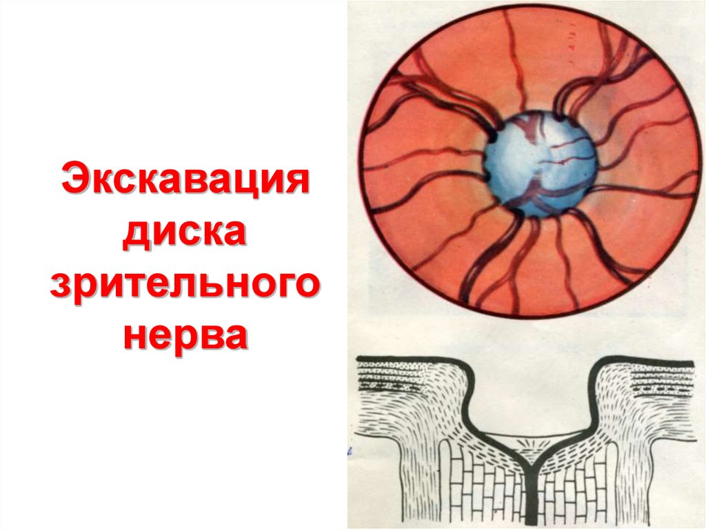 Норма зрительного нерва. Краевая экскавация диска зрительного нерва. Глаукоматозная экскавация зрительного нерва. Экскавация зрительного нерва норма.