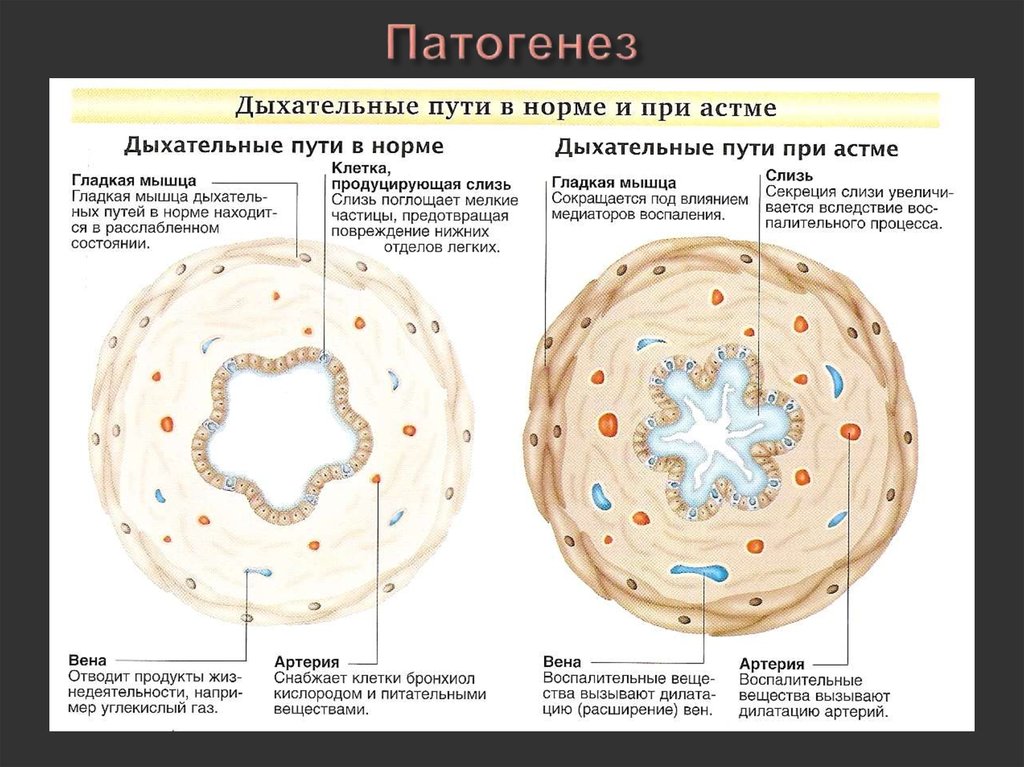 Патогенез пневмонии схема