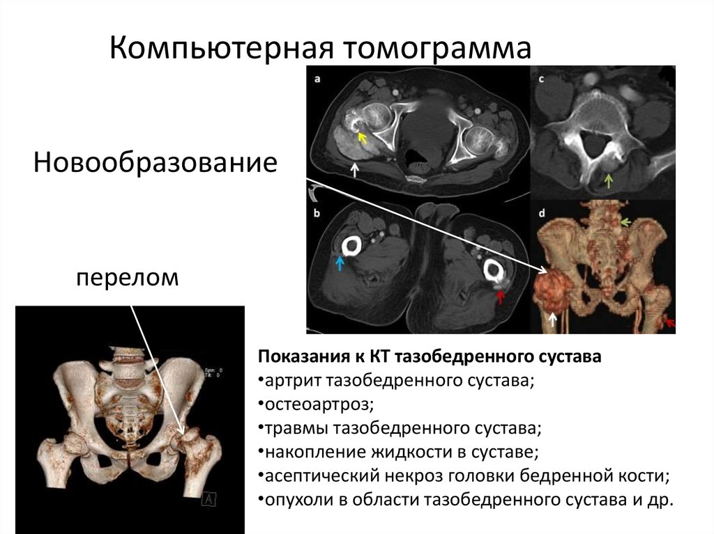 Кт тазобедренного сустава фото